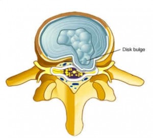 Herniated Disc - AKSIS Special Hospital