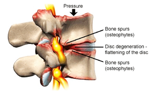 Degenerative Disc Disease