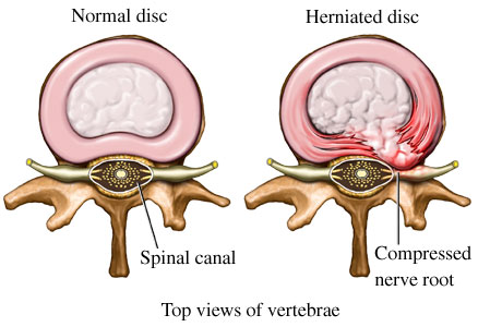 What Causes Herniated Discs?